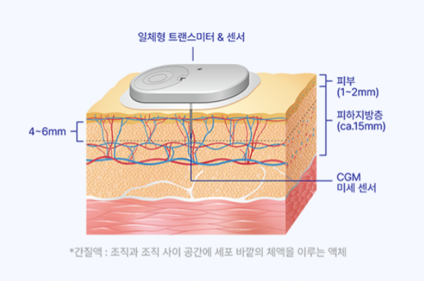 연속혈당측정 원리